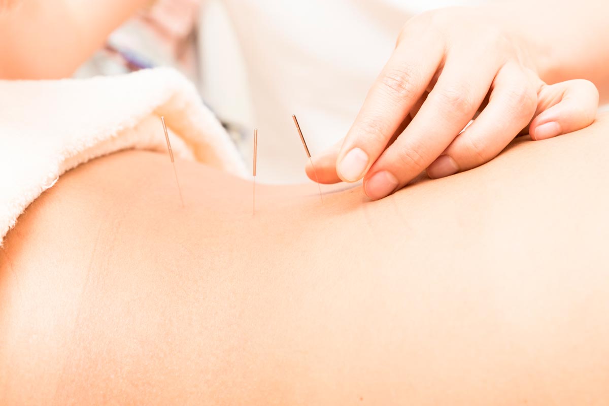 The Traditional Chinese Medicine (TCM) practice of acupuncture has been used around the world for promoting health and wellbeing for more than 2000 years. 